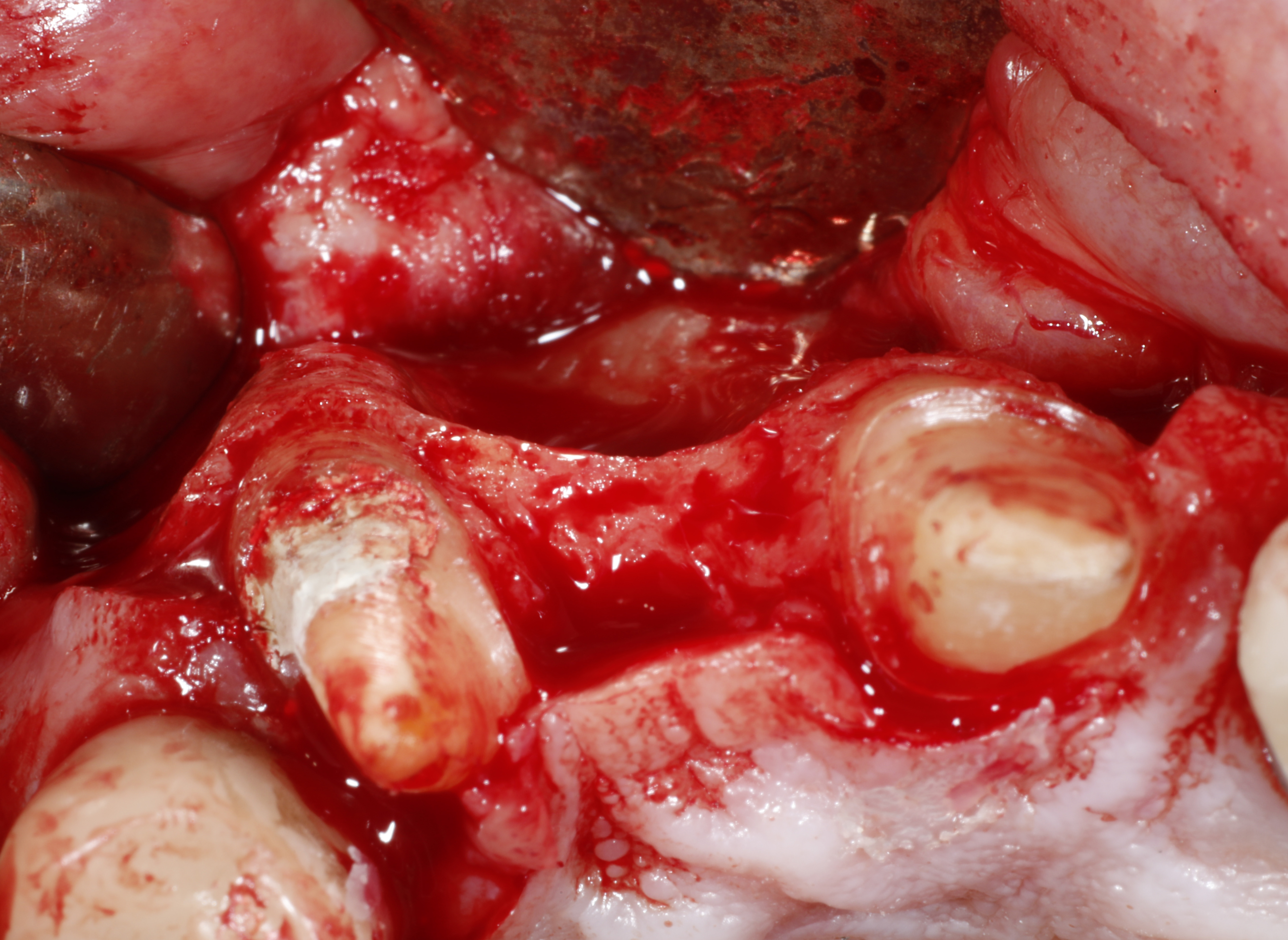 soft tissue management in ridge augmentation