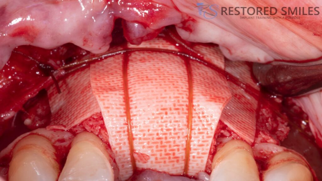 hands-on ridge augmentation course