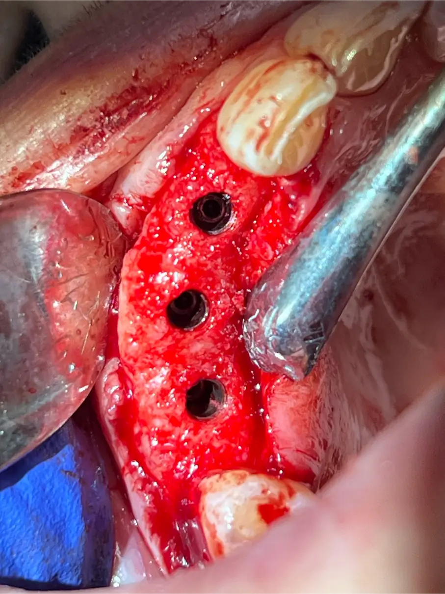 Consider Implant Dentistry