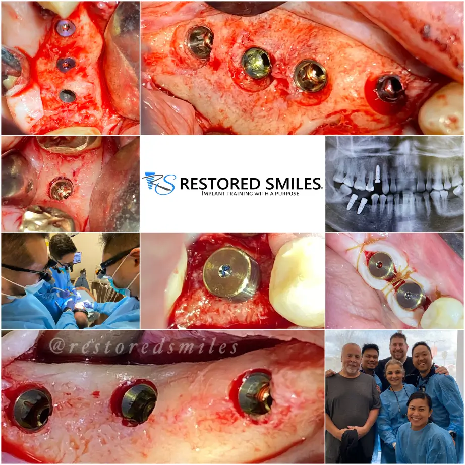 What Should Be Different Six Months After Your Implant CE
